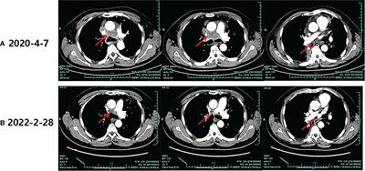 ALK-R3HDM1 and EML4-ALK fusion as a mechanism of acquired resistance to gefitinib: A case report and literature review